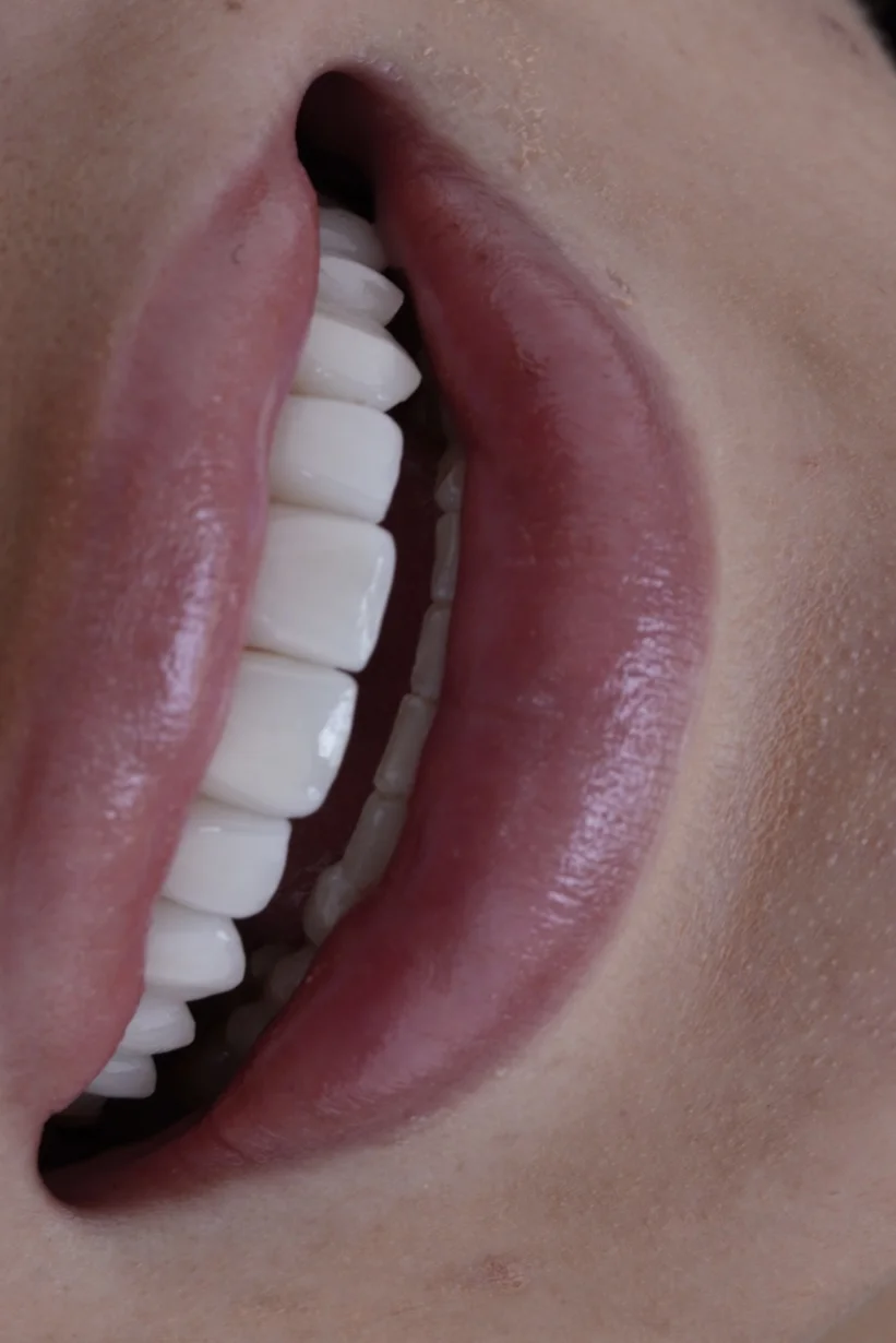 Smile Result Case 1