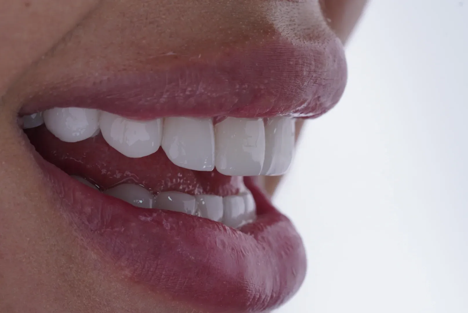 Smile Result Case 6