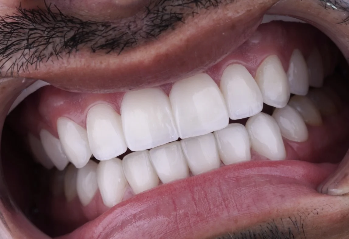 Smile Result Case 2