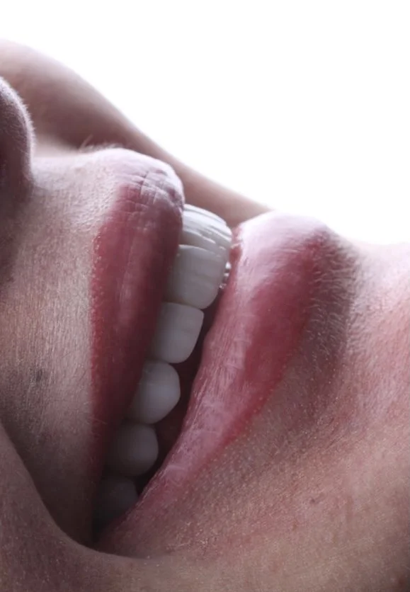 Smile Result Case 5