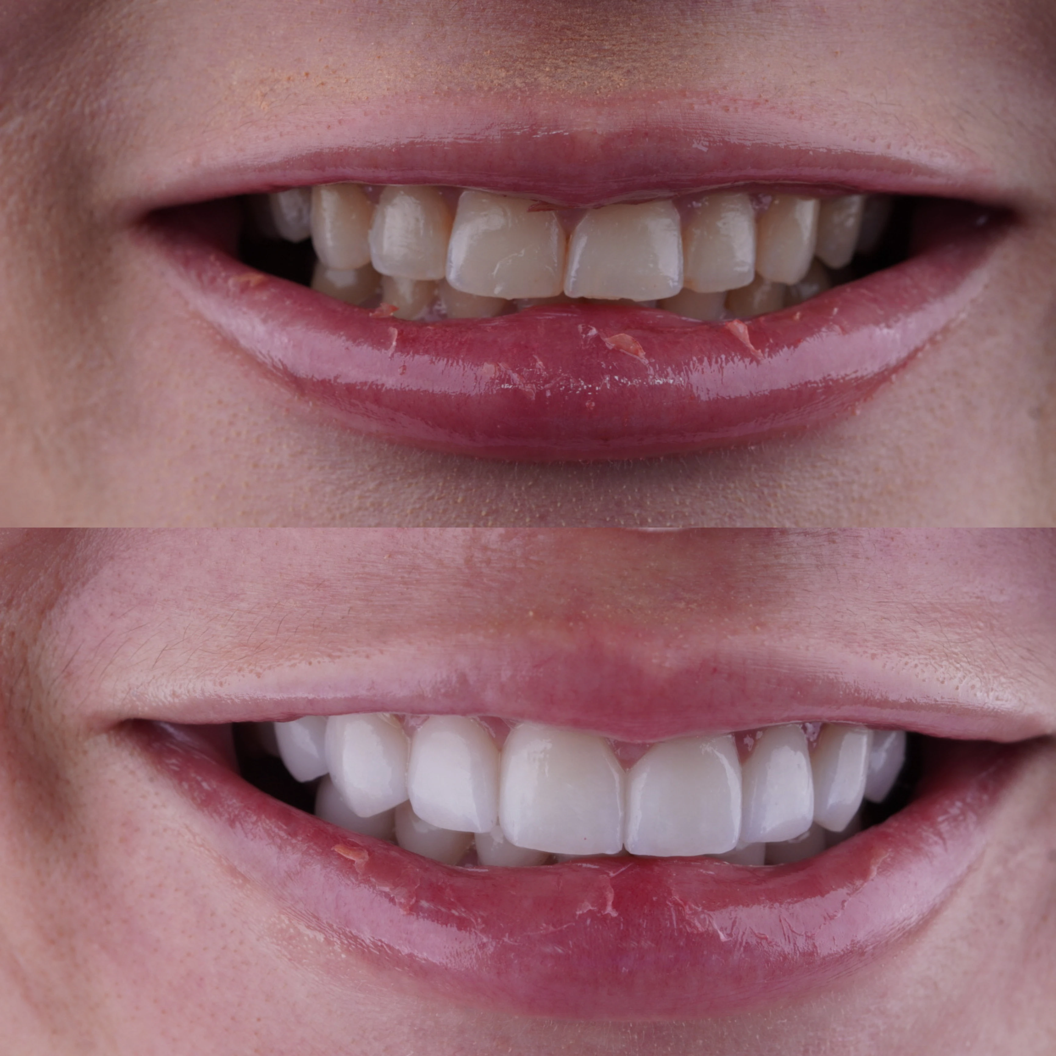 Before and After Smile Design Case - Dr. Sonia Herrera
